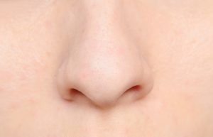 Nasal polyps can result from chronic inflammation due to asthma, infection and allergies