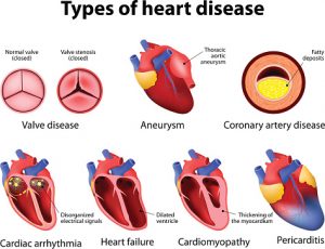 Lupus and pericarditis: Effect of lupus on heart health
