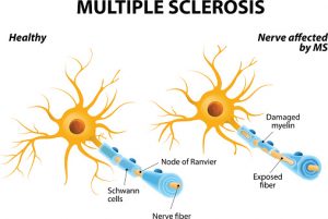 Multiple sclerosis paroxysmal symptoms confused with seizures due to sudden onset