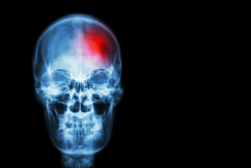 Shocking: 73 percent of stroke p...