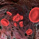 In rheumatoid arthritis patients, anemia, low hemoglobin levels linked to disability and impairment