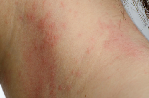 Contact dermatitis, skin rash fr...