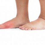 Gout linked to increases diabetes risk