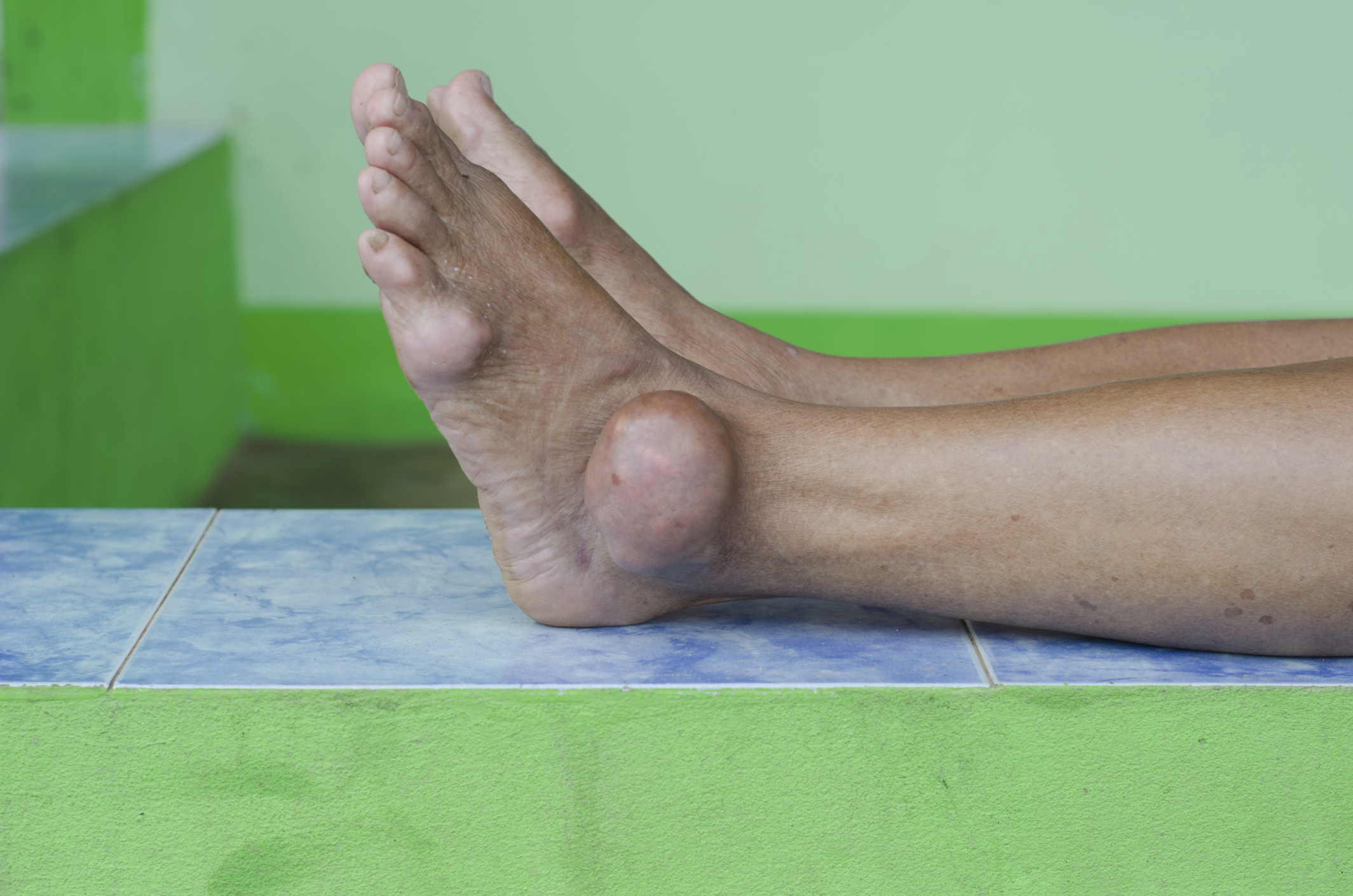 What is Gout (gouty arthritis)? ...