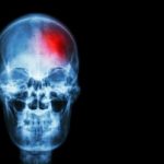 Migraine headaches with auras