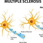 Multiple sclerosis paroxysmal symptoms