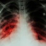 New-imaging-technique-aids-earlier-diagnosis-of-fungal-lung-infection