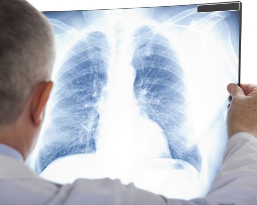 Scleroderma related interstitial lung disease can be treated with new promising treatment