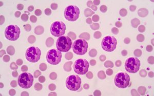 Neutropenia, deficiency of neutrophils can cause bacterial and fungal infection