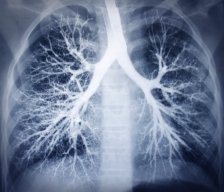 Lupus affects lungs, leads to pl...