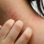 natural-remedies-for-eczema