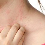 Signs and symptoms of contact dermatitis