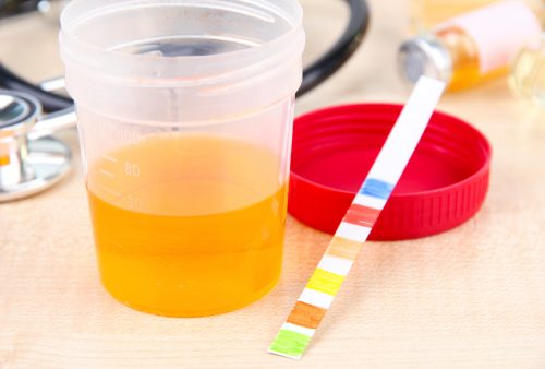 Urinary tract infections(UTI) influenced by person’s diet and acidity of urine
