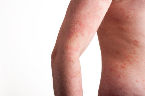 Psoriasis is a chronic kidney di...