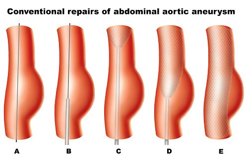 abdominal-aortic-aneurism-risk-may-decrease-with-more-than-two-fruit-servings