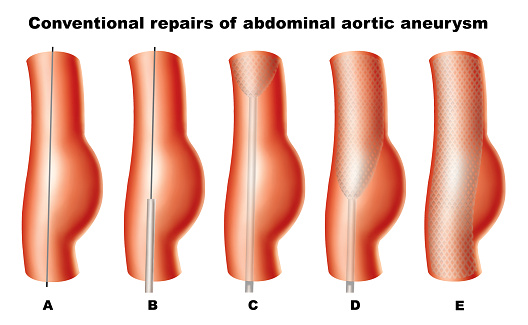 Abdominal aortic aneurysm risk m...