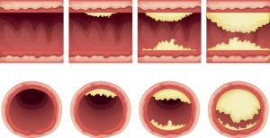 atherosclerosis