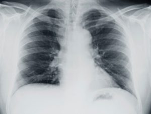 In cystic fibrosis patients, lung infection can be caused by bacterial infection