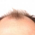 prostate cancer and baldness