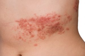 senior shingles patience unlikely to have recurrence of painful skin condition