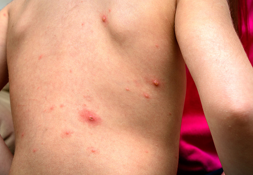 Shingles may be related to incre...