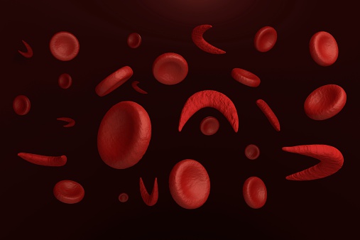Sickle cell disease in pregnant ...