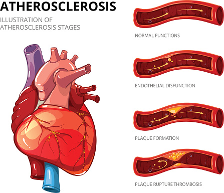 Systemic Sclerosis Scleroderma Is An Independent Risk Factor For Atherosclerosis