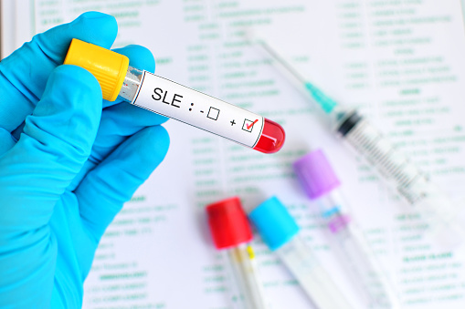 Systemic Lupus Erythematosus (SL...
