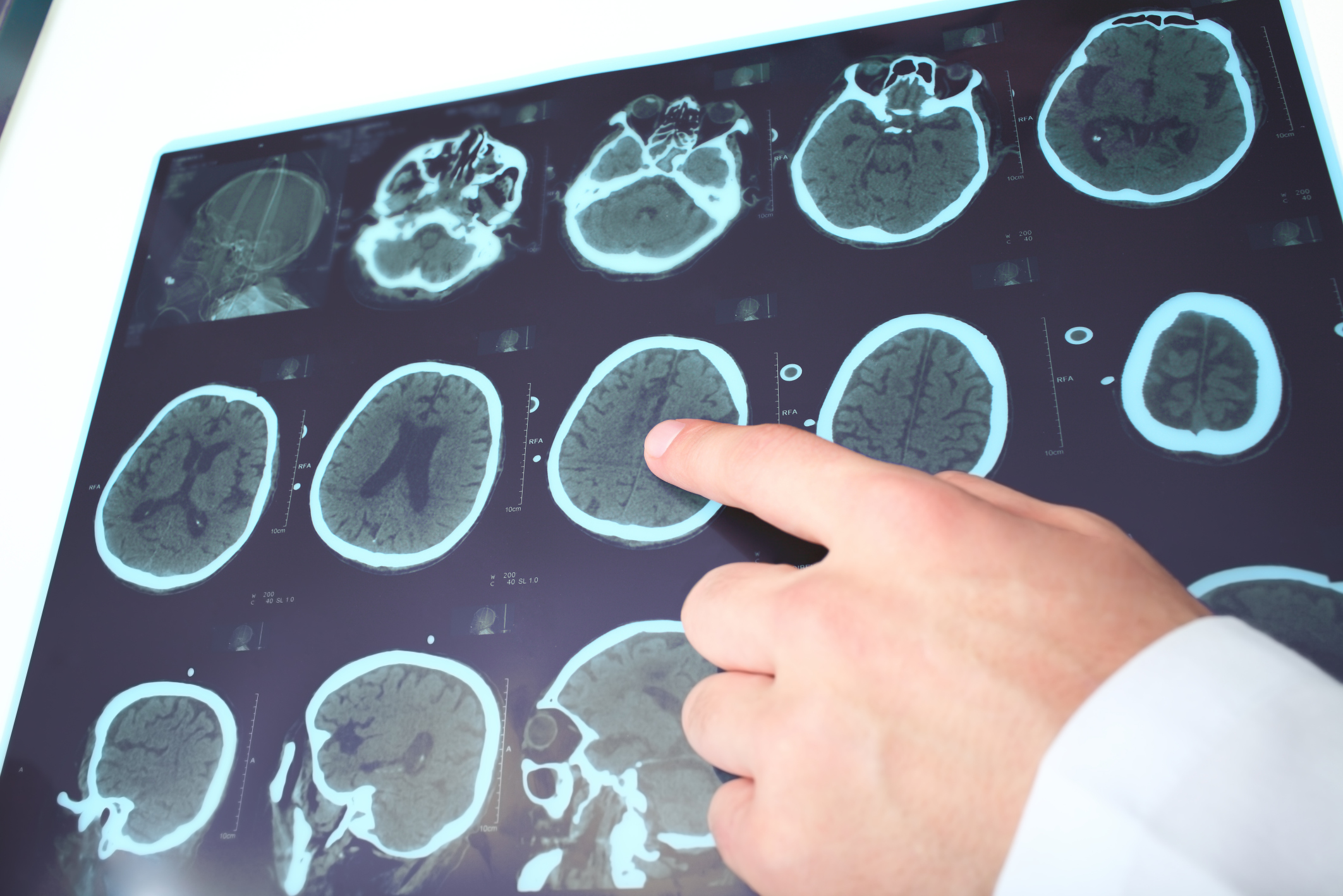 Traumatic brain injury (TBI) lin...