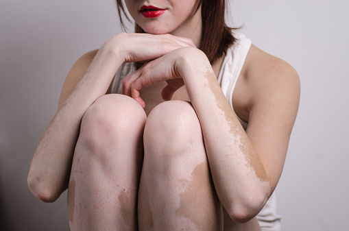 Vitiligo linked to simultaneousl...