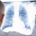 Scleroderma-related interstitial lung disease