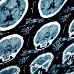 Hypertension drug blocks TBI