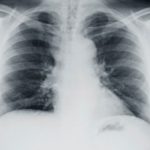 cystic fibrosis patients