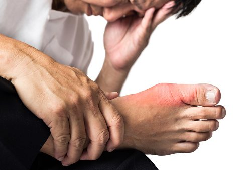 Gout vs osteoarthritis differences, treatment, and natural remedies