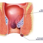 Hemorrhoids (piles) triggered by pregnancy, constipation, relieved by home remedies and exercise