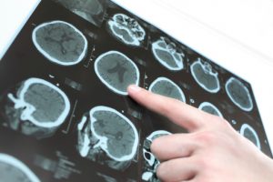 Parkinson’s disease 2016 update: risk higher with iron overload, new treatment target identified