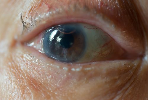 Prevent cataracts naturally home remedies