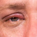 Shingles (herpes zoster) eye infection 