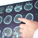 Traumatic brain injury