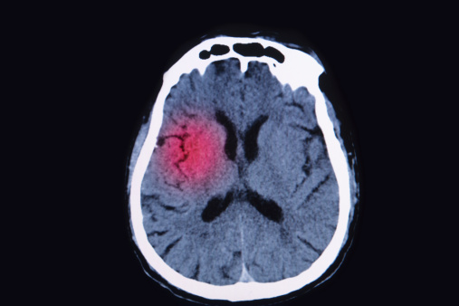 Traumatic brain injury (TBI) ris...