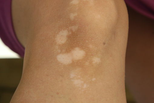 Vitiligo may increase thyroid di...