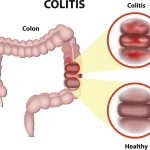 Inflammatory bowel disease and irritable bowel syndrome may share symptoms but are not the same