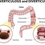 Diverticulitis irritable bowel syndrome