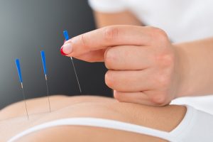 Endometriosis pain relief with acupuncture