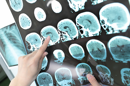 Multiple sclerosis may double ea...