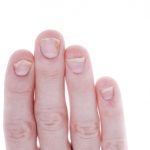 Nail psoriasis and psoriatic arthritis symptoms connected