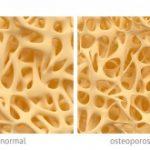 Osteoporosis can be reversed by stem cell therapy