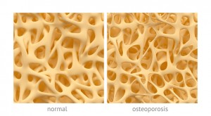 Osteoporosis Awareness and Preve...