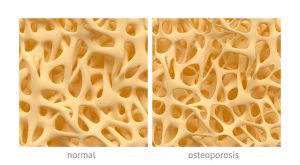 Osteoporosis can be reversed by stem cell therapy, new potential treatment