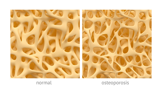 Osteoporosis can be reversed by ...